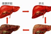 早期肝硬化的症状及警示信号（了解早期肝硬化的关键症状）
