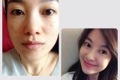 有效去除青春痘的方法（探索清除青春痘的最佳途径）