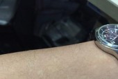 得白点癫风的前兆是什么？症状有哪些？