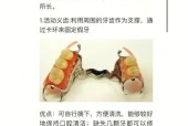 拔牙后镶牙的最佳时间与注意事项（恢复期）