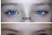 斜视的原因及预防方法（揭秘导致斜视的危险因素）