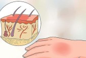 烫伤了怎么办？烫伤处理步骤有哪些？