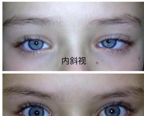 斜视的原因及预防方法（揭秘导致斜视的危险因素）  第1张
