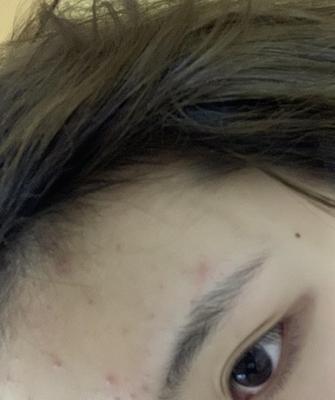告别额头痘痘，重拾自信笑容（自我调理）  第2张