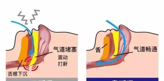 解决睡觉打呼噜问题的方法（如何有效减轻睡眠呼噜）  第3张