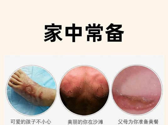 热油烫伤处理方法（急救措施及后续护理指南）  第1张