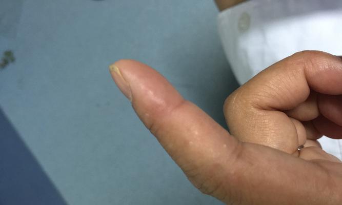 手指上的小水泡——原因、治疗和预防方法  第1张