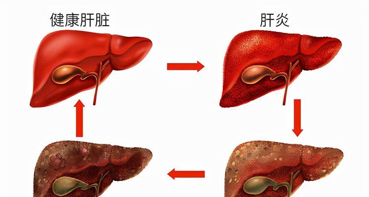 早期肝硬化的症状及警示信号（了解早期肝硬化的关键症状）  第1张