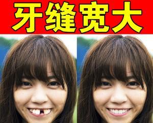门牙牙缝变大是如何造成的（探究门牙牙缝变大的原因及治疗方法）  第3张