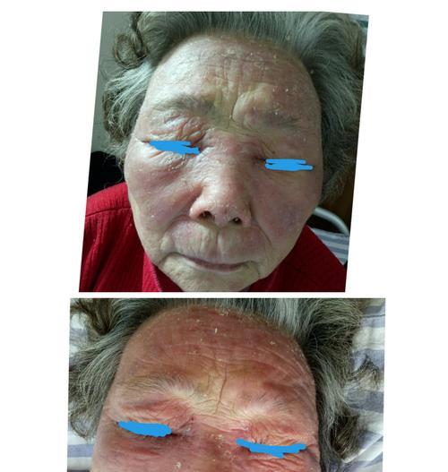 一招断根日光性皮肤病的办法是什么？如何有效预防和治疗？  第2张