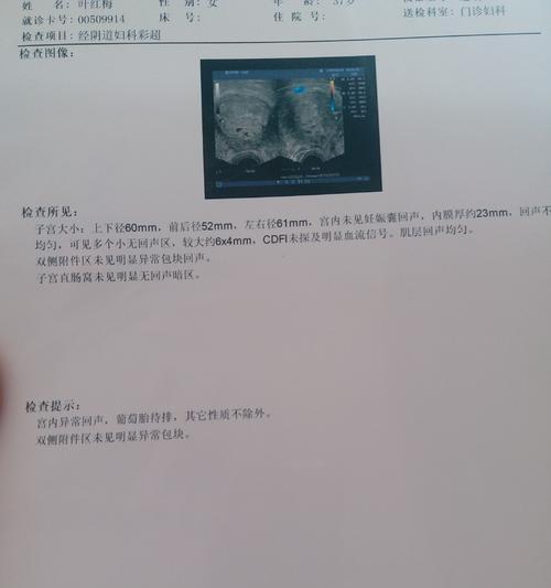 怀孕初期葡萄胎有哪些症状？如何识别葡萄胎的早期迹象？  第1张