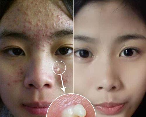 如何快速去除痘疤？6个有效方法大公开！  第2张