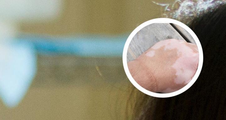 得白点癫风的前兆是什么？症状有哪些？  第3张