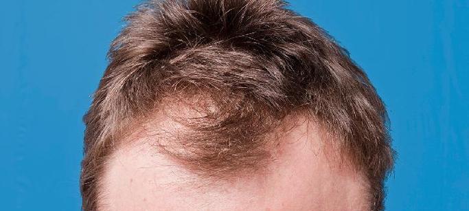 导致脱发的13个原因是什么？如何预防和治疗？  第1张